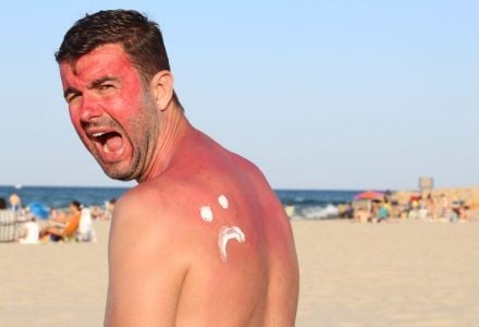 9 remedios naturales para quemaduras solares (el 5 te sorprenderá)